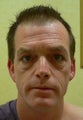 38 year old man has Phenol Peel