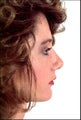 Rhinoplasty