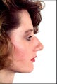 Rhinoplasty