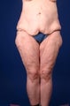 42 Year Old Weight Loss Patient
