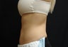 Coolsculpting