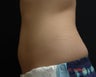 Coolsculpting