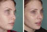 Female Revision Rhinoplasty