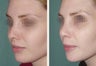 Female Revision Rhinoplasty