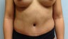 Tummy Tuck
