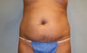 Tummy Tuck