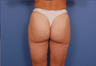 Liposuction