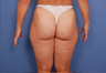 Liposuction