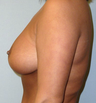 Breast Lift