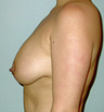 Breast Lift