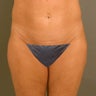 44 Year Old Female Underwent VASER Liposelection to Her Stomach