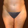 44 Year Old Female Underwent VASER Liposelection to Her Stomach