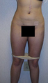 Liposuction