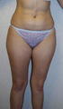 Liposuction