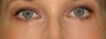 Bilateral Lower Blepharoplasty