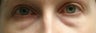 Bilateral Lower Blepharoplasty