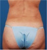 35 y/o; vaser lipo treatment for flank lipodystrophy