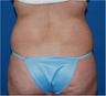 35 y/o; vaser lipo treatment for flank lipodystrophy