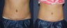 Before & After CoolSculpting