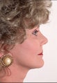 Rhinoplasty and Face Lift