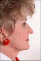 Rhinoplasty and Face Lift