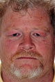 Eyelid Surgery