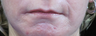 Laser resurfacing around mouth with subcision