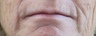 Laser resurfacing around mouth with subcision