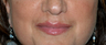 Non-surgical Lip Augmentation for Improved Contour and Definition