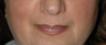 Non-surgical Lip Augmentation for Improved Contour and Definition
