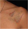 Tattoo Removal