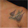 Tattoo Removal