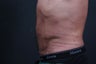 Athletic male who benefited from endoscopic lower abdominal wall tightening.
