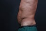 Athletic male who benefited from endoscopic lower abdominal wall tightening.