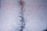 Laser Hair Removal