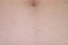 Laser Hair Removal