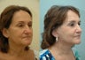 Facelift, Lower Eyelid Surgery & Fat Transfer