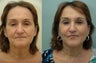 Facelift, Lower Eyelid Surgery & Fat Transfer