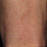 Patient treated with sclerotherapy for small varicose veins / reticular veins of the back of the leg