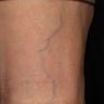 Patient treated with sclerotherapy for small varicose veins / reticular veins of the back of the leg