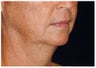 Facelift