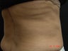 Coolsculpting