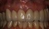 Crown Lengthening