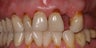 Crown Lengthening