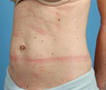 truSculpt
