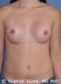Transgender Breast Augmentation