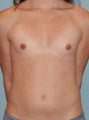 Transgender Breast Augmentation