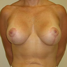 Breast Lift