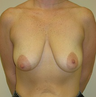 Breast Lift