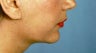 Before and After Chin Procedure